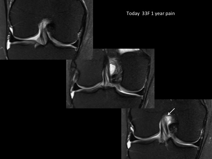 Figure 1 for case anterior cruciate ligament ( RID2781 )